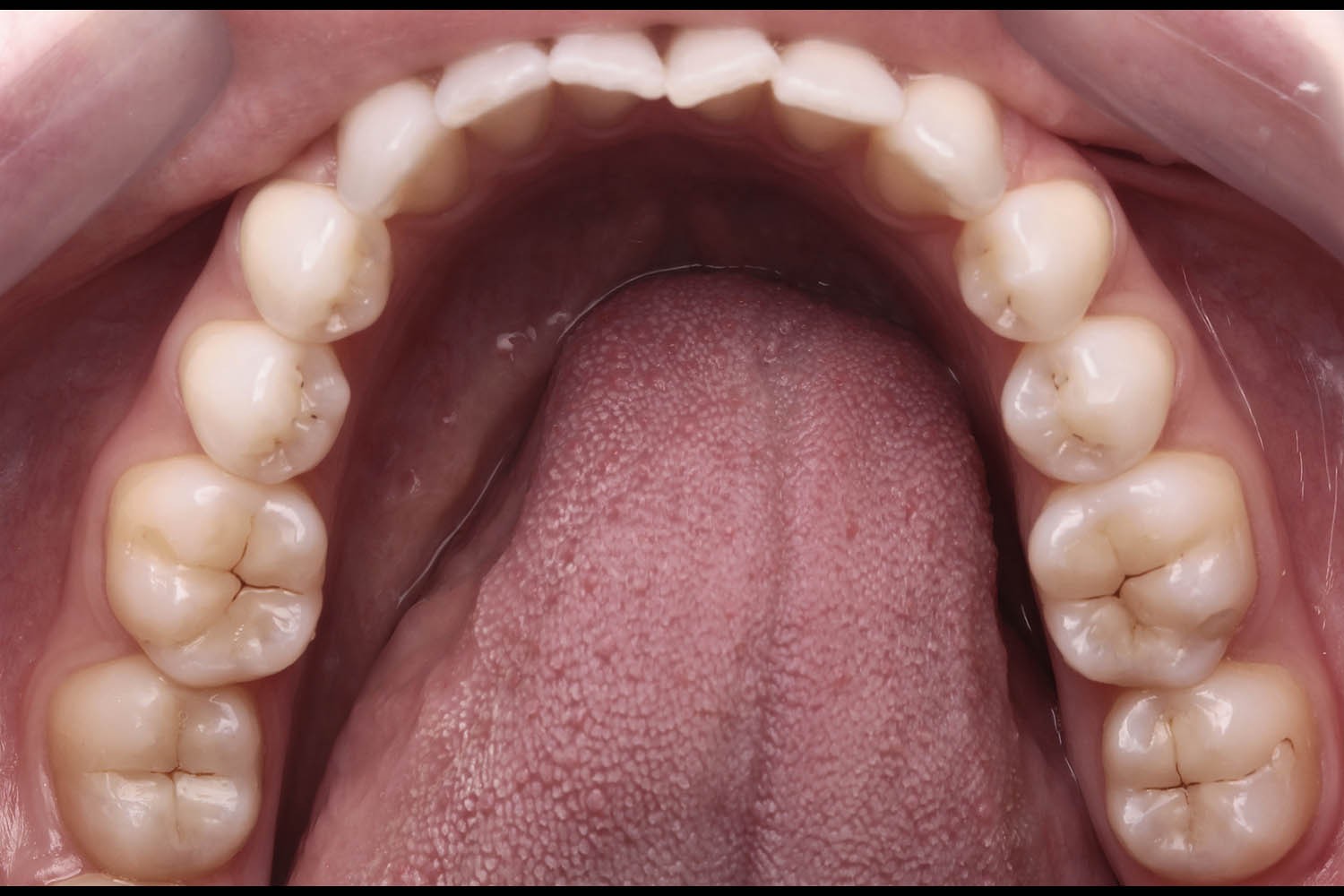 Técnica de Substituição Natural de Esmalte e Dentina: Restauração Simplificada Dentes Posteriores