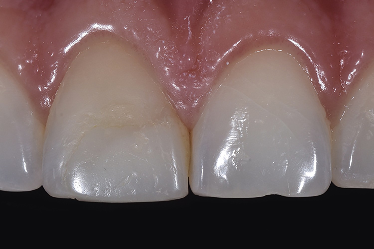 Coroa e Laminado Cerâmico: Solução Estética para Dentes que Sofreram Trauma