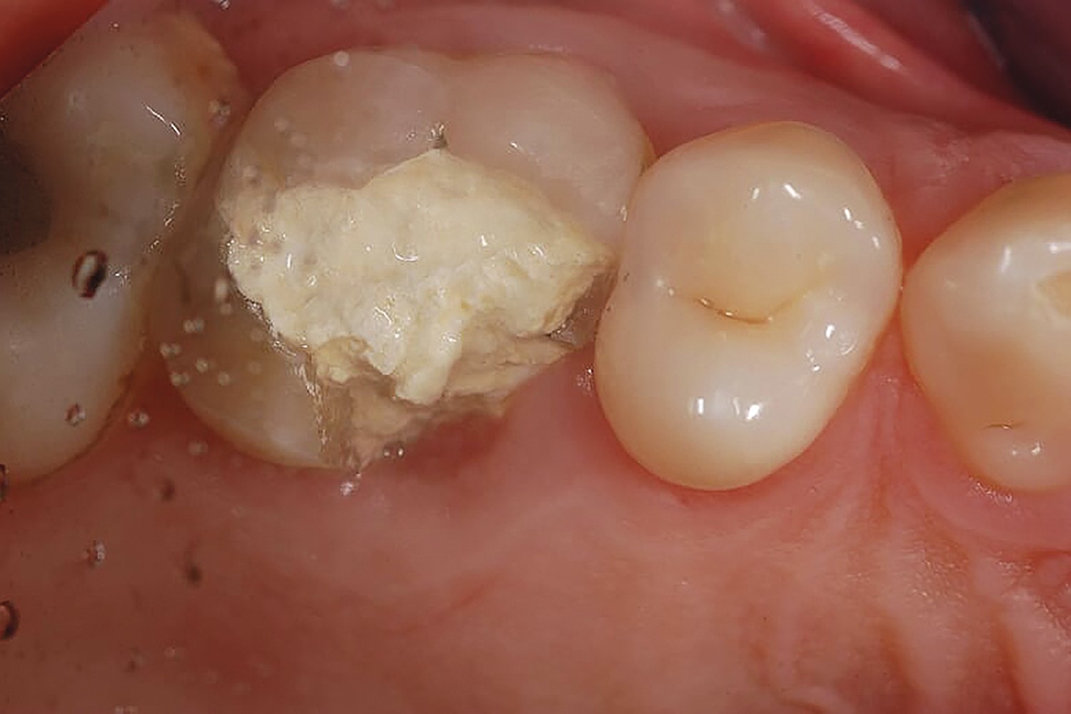 Cracked Tooth Syndrome: integrated aspects of rehabilitation: A case report