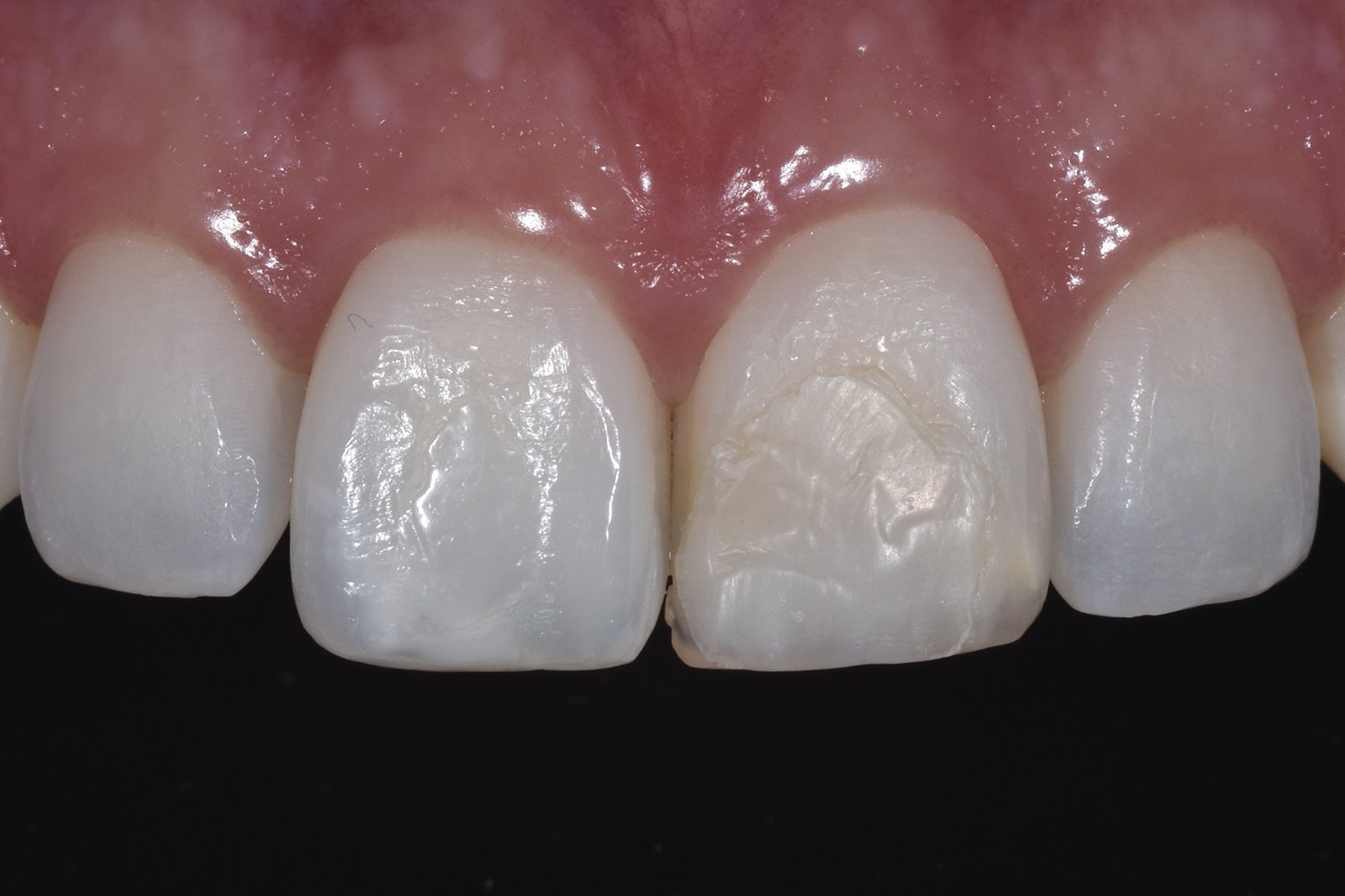 Soluções Clínicas Conservadoras para Hipomineralização do Molar-Incisivo