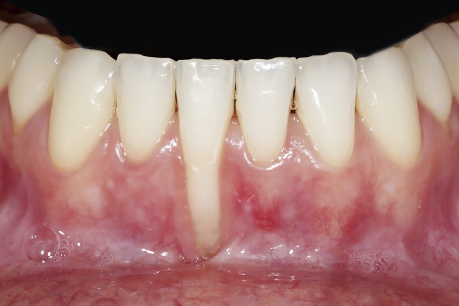 Enxerto de Tecido Conjuntivo p/ Recob. Radicular em Reg. Ant. de Mandíbula pela Téc. de Tunelização