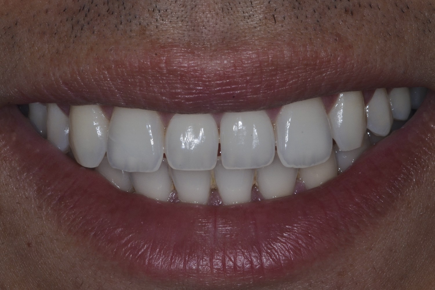 Reabilitação estética e funcional em paciente com rara transposição bilateral em incisivos superiore