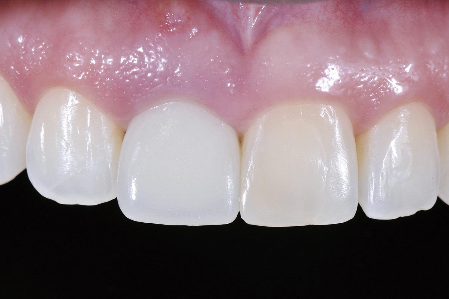 The aesthetic challenge of implant- and tooth-supported anterior rehabilitations