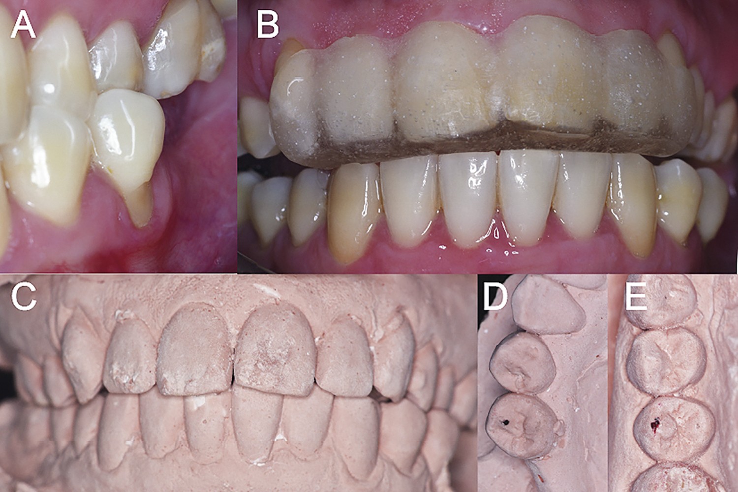 Trauma oclusal como fator predisponente de risco para doença periodontal localizada