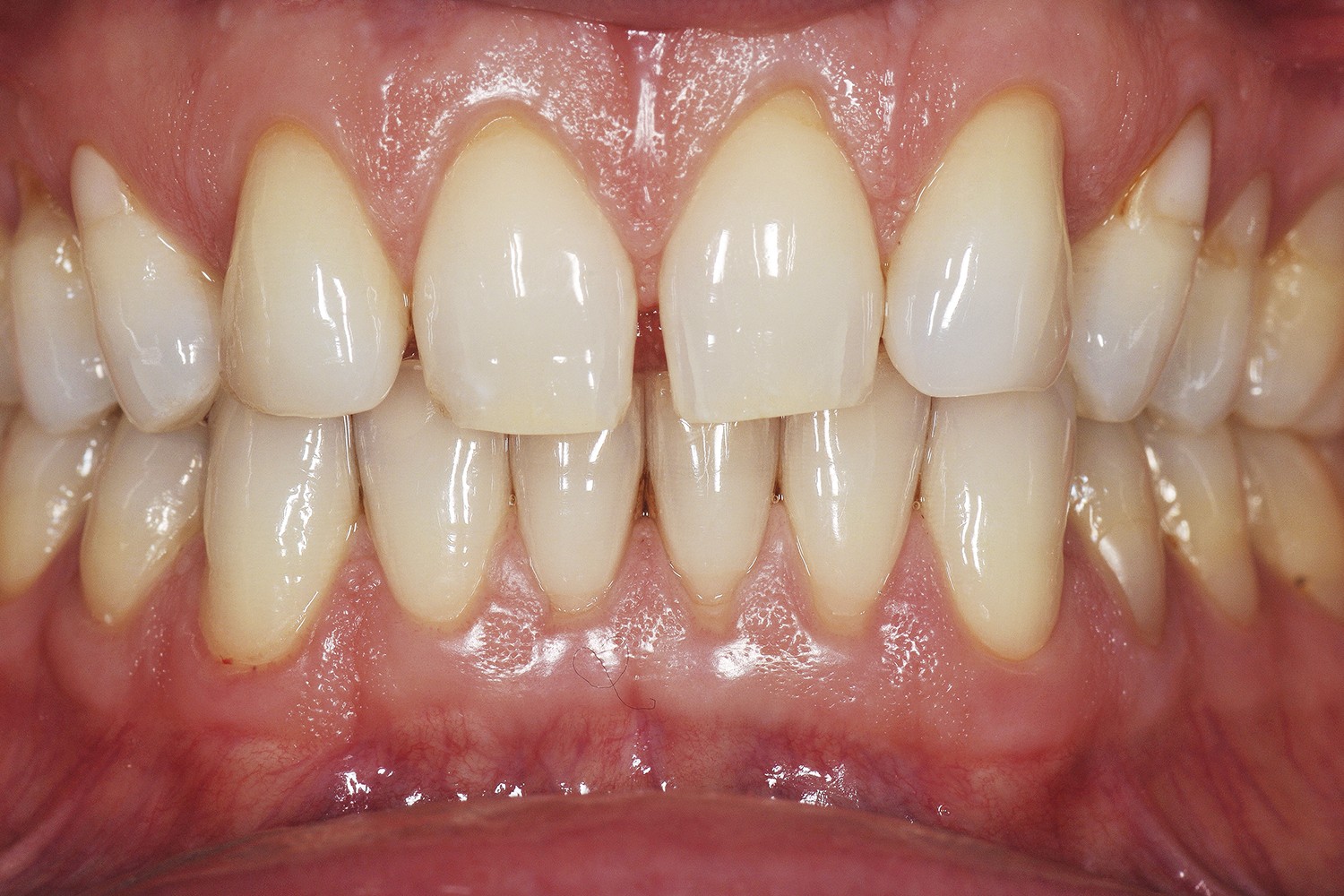 Combinações Anatômicas Dentárias: Um Guia para Estética Dentária Definitiva