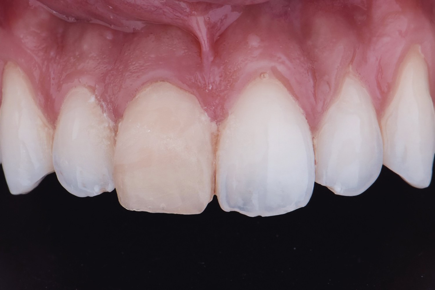 Fratura extensa de dente anterior vital: um desafio estético e biológico