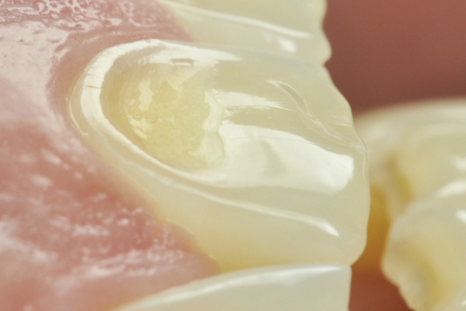 Digitally-guided direct composite resin: Guiding the predictability of direct restorations