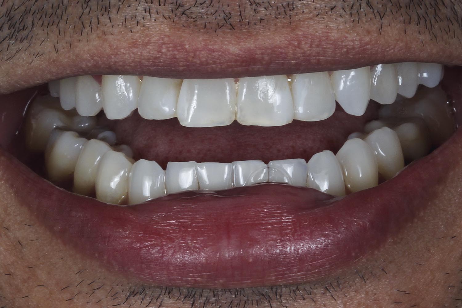Utilização do enceramento-diagnóstico direto em boca em reabilitação estética com cerâmica