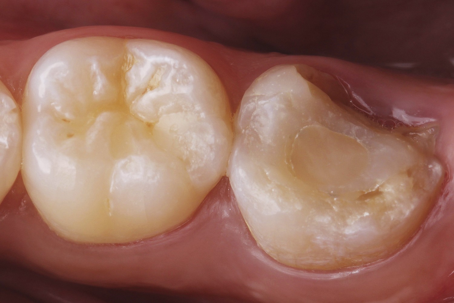 Tratamento conservador para fratura dental envolvendo cúspide: Relato de caso clínico