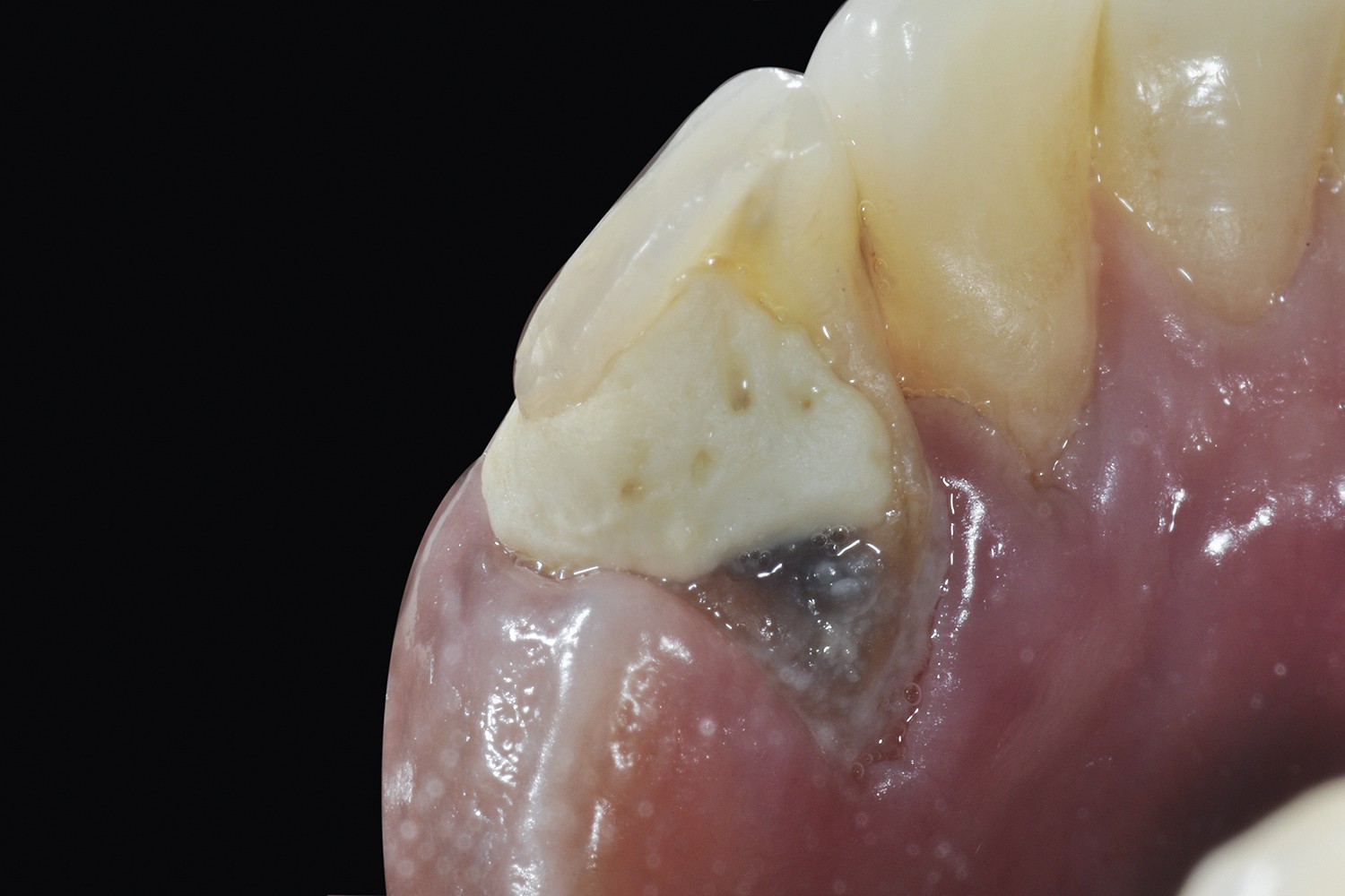 Relevância do Núcleo Metálico Fundido em Dente-base de PPR