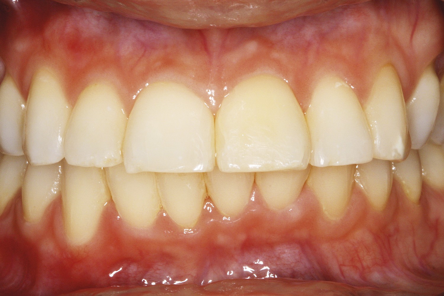 Alternative whitening in isolated tooth with dystrophic pulp calcification