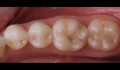 Figura 2. Aspecto clínico inicial, restaurações de resina composta nos dentes 36 e 37, com presença fenda marginal perceptível à sondagem, relato de choques mecânicos ao mastigar, falta de material restaurador na região da fossa central do 36 e insatisfação estética do 36 e 37, pois considerava que a restauração estava muito amarelada e diferente da cor do dente natural.