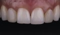 Figura 2: Aspecto intraoral demonstrando alterações de cor e forma dos incisivos laterais.