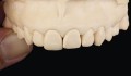 Figura 3: Guia estético em resina composta confeccionado para orientação de posicionamento de bordo incisal para confecção do DOOR.