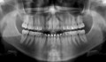 Figura 2: Imagem radiográfica panorâmica mostrando presença de tecido ósseo nas regiões interproximais ao elemento 41.