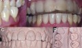 Figura 1: A) Dente 35 com abfração e recessão gengival. B) “Front plateau” para desprogramar a propriocepção que leva a mandíbula a evitar o contato prematuro, induzindo seu deslocamento para a posição de máxima intercuspidação habitual. C) Modelos montados em articulador semiajustável na posição de relação central. 
D) Ponto de contato prematuro no dente 35 evidenciado no modelo montado em articulador semiajustável na posição de relação central. E) Ponto de contato prematuro no dente antagonista evidenciado no modelo montado em articulador semiajustável na posição de relação central.