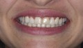 CASO 1
Figura 1: Foto iniciaL do sorriso da paciente do caso 1.