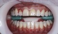 CASO 1
Figura 3: Cirurgia plástica periodontal.