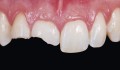 Figuras 1b: Lesões dentais traumáticas anteriores. / Anterior Traumatic Dental Injuries.