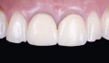 Figuras 2a-2g: Tratamento com coroas convencionais em paciente do sexo masculino que comentou ter fratura leve nas bordas incisais de seus incisivos centrais antes de serem feitas as primeiras coroas. / Treatment with conventional crowns in a male patient who commented of having a minor fracture of the incisal edges of his central incisors before the first crowns were done.