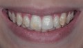Figuras 1A-1F: Fotografias iniciais de sorriso e intra orais com visão lateral direita, frontal e lateral esquerda. Observa-se a presença de manchas opacas nos dentes ântero-superiores e dentes saturados.