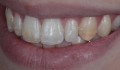 Figuras 1A-1F: Fotografias iniciais de sorriso e intra orais com visão lateral direita, frontal e lateral esquerda. Observa-se a presença de manchas opacas nos dentes ântero-superiores e dentes saturados.