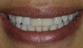 Figura 1. Aspecto inicial do sorriso.