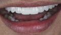 Figura 2: Enceramento-diagnóstico com resina composta. a) Intraoral; b) extraoral.
