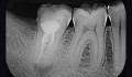 Figura 2: Aspecto radiográfico inicial do elemento 47 apresentando lesão periapical e obturação deficiente dos canais radiculares.