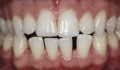 Figura 1: Aspecto inicial do caso – halo escurecido na região interproximal dos dentes 11 e 21.