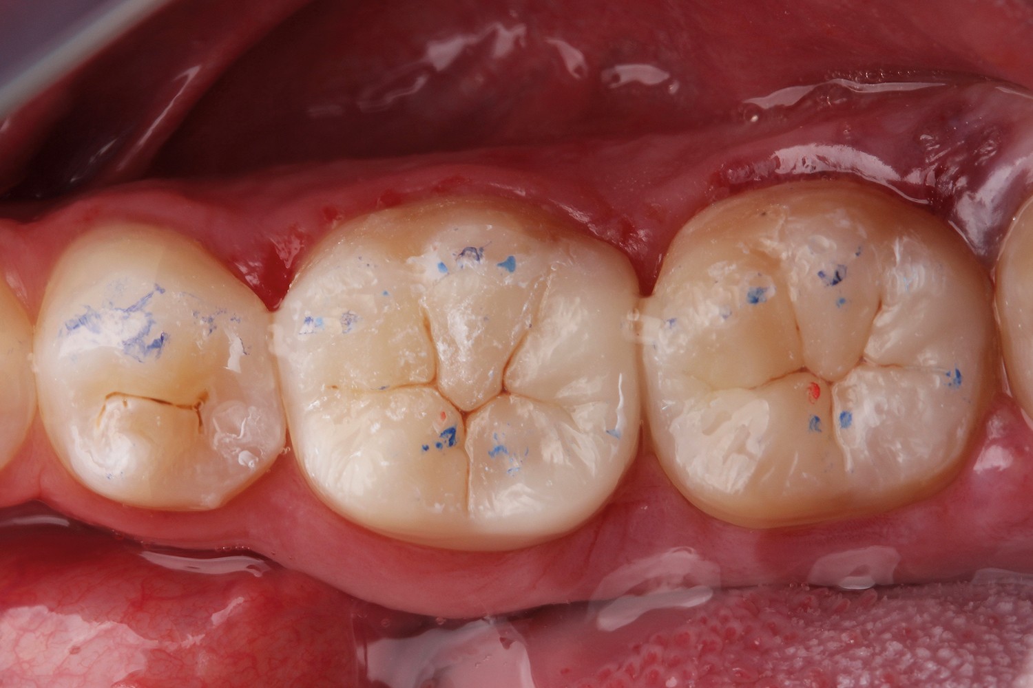 Overposition of points technique to facilite and improve the occlusal adjustment