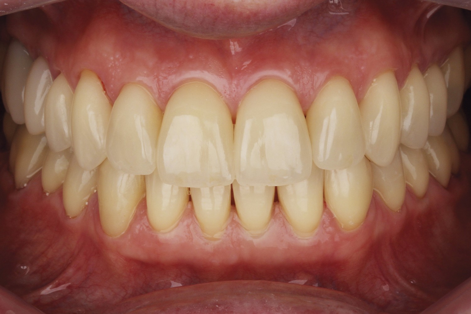 Natural enamel and dentin replacement technique with the 2 and 2 Concept