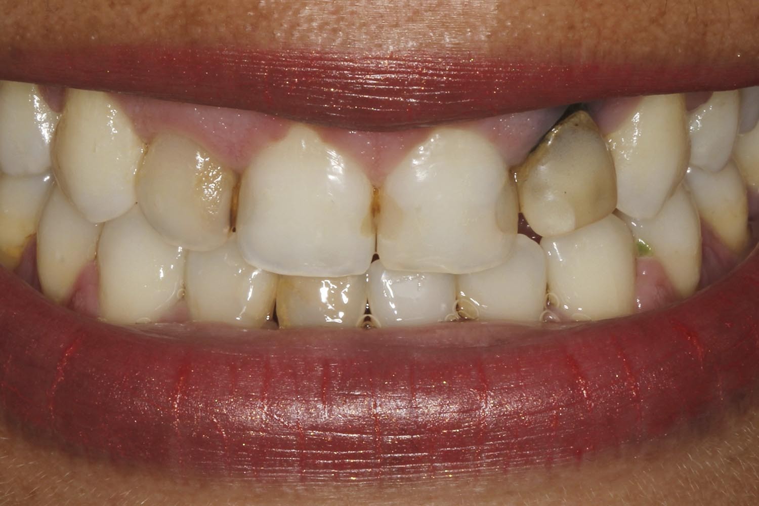 Multidisciplinary planning for aesthetic implants