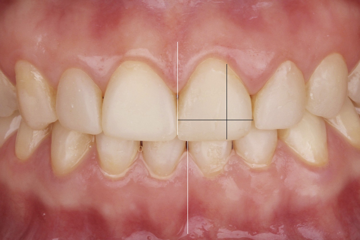 Um Novo Conceito em Reabilitação Oral: 2and2 CONCEPT